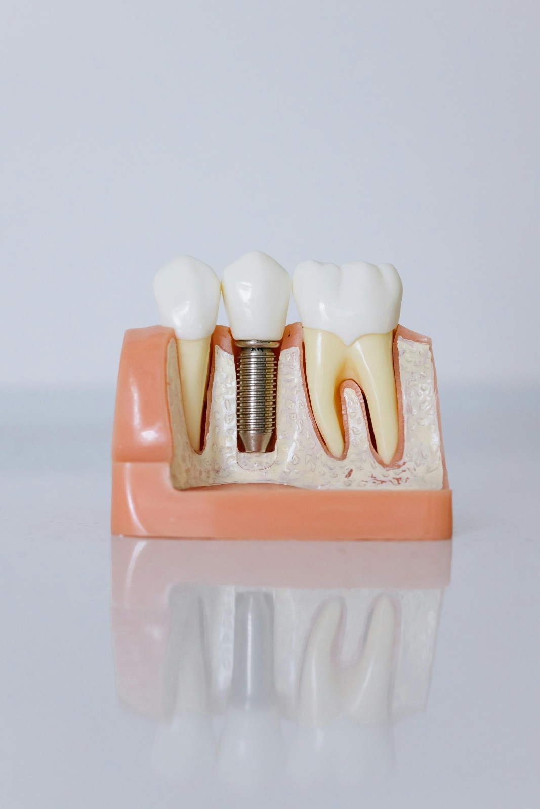 Natural Tooth
